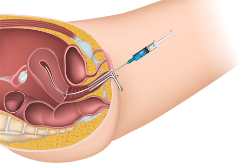 IUI Treatments Hospital in Anand, Gujarat